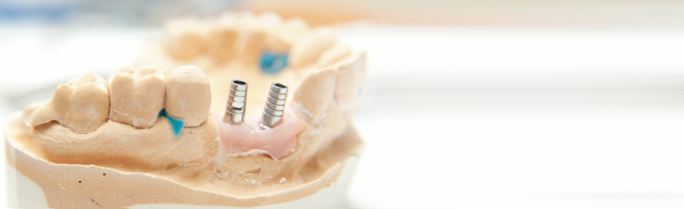 Kosten für Zahnersatz und Zahnbehandlungen